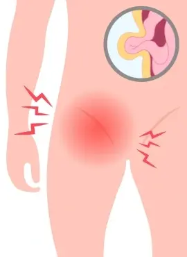 Hernia-Inguinal Cirugía de Hernia Inguinal en Iztapalapa