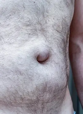 Cirugía de Hernia Umbilical en Iztapalapa