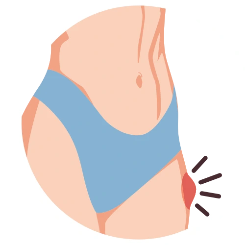 Cirugía de Hernia en Iztapalapa