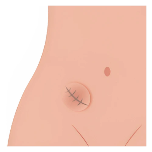 Cirugía de Hernia en Iztapalapa