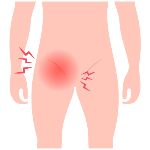 Cirugía de Hernia en Iztapalapa