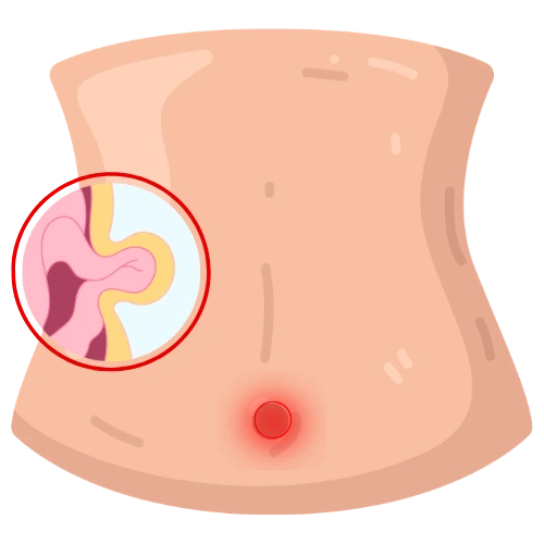 Cirugía de Hernia en Iztapalapa
